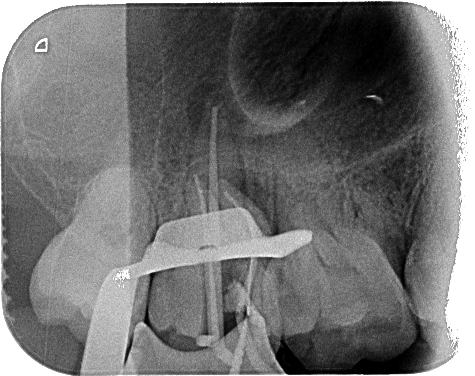 Master Endodoncia Caso clínico Master Molar Prenavideño