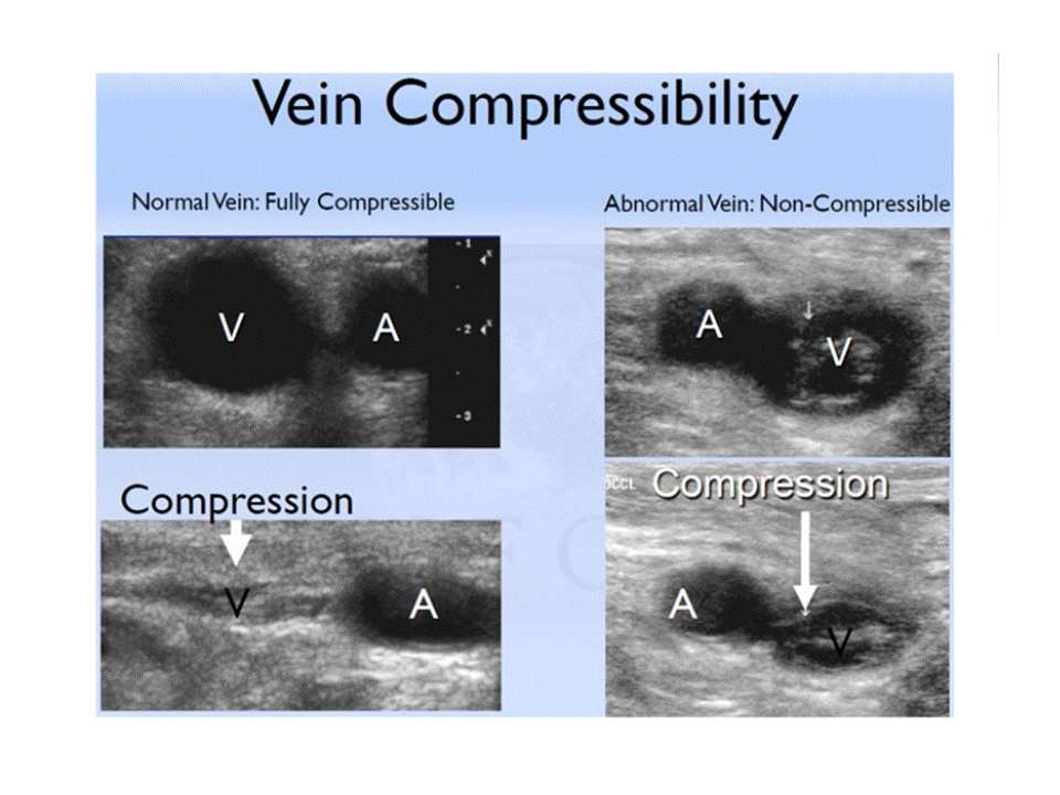 BÀI SOẠN VỀ SIÊU ÂM CHẨN ĐOÁN Acute and Chronic DVT and Ultrasound (US)