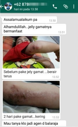 Cara Mengobati Infeksi Kulit Selulitis Secara Alami Sampai Tuntas Cara Mengobati Infeksi Kulit Selulitis Secara Alami Sampai Tuntas