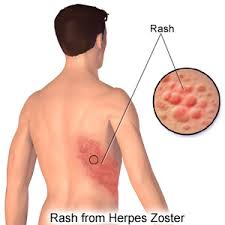 Cara Jitu Menyembuhkan Herpes Zoster
