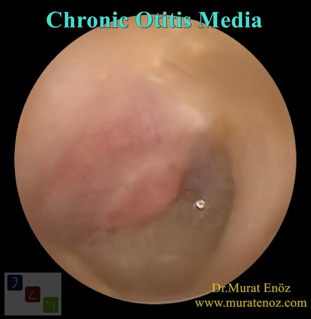 Chronic Otitis Media - Definition of Chronic Otitis Media - Symptoms of Chronic Otitis Media - Complications of Chronic Otitis Media - Treatment of Chronic Otitis Media