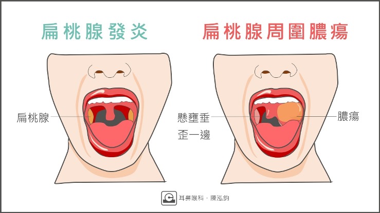 扁桃腺性病 性病が舌や喉に感染？梅毒、淋病、クラミジア、ヘルペス、HIVに注意