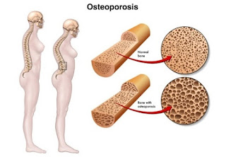 Ramuan herbal untuk osteoporosis