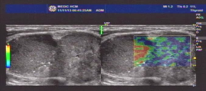 Vietnamese Medic Ultrasound Case 218 Left Supraclavicular Mass Dr