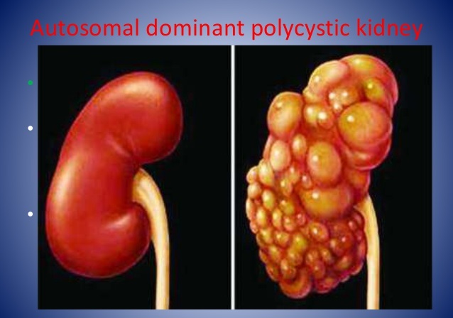 Adult polycystic kidney disease Adult polycystic kidney disease