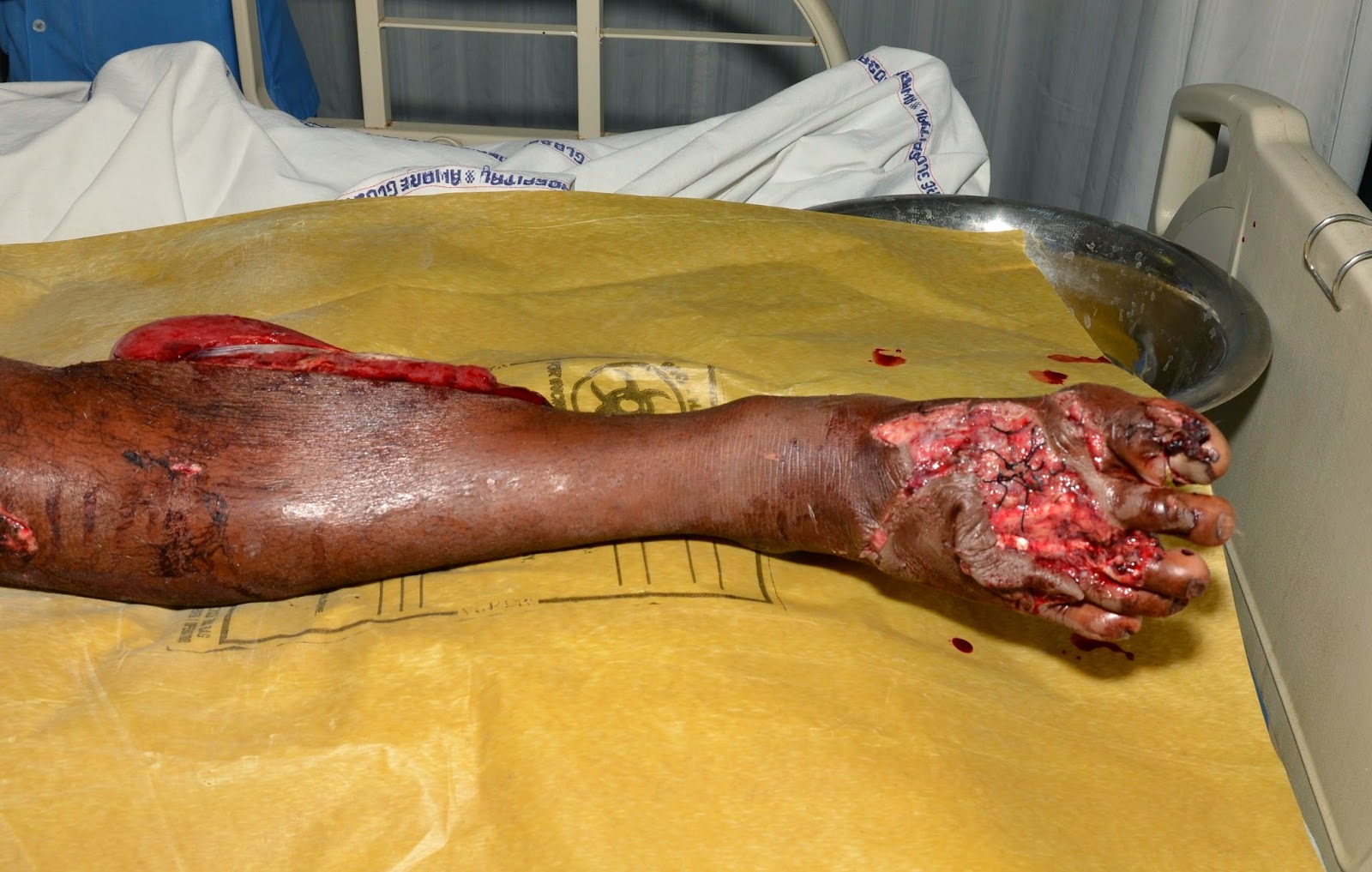 Fractured Ankle Recovery Fracture Treatment