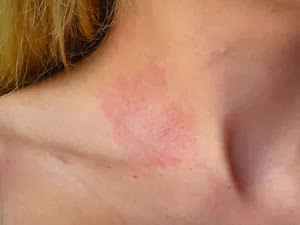 Allergic contact dermatitis 1