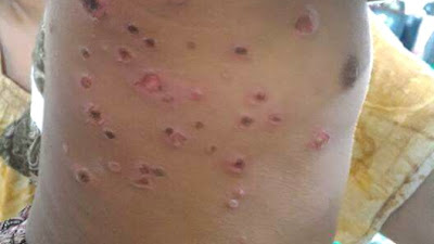 Penyakit Herpes Mulai Mewabah di Kota Bima