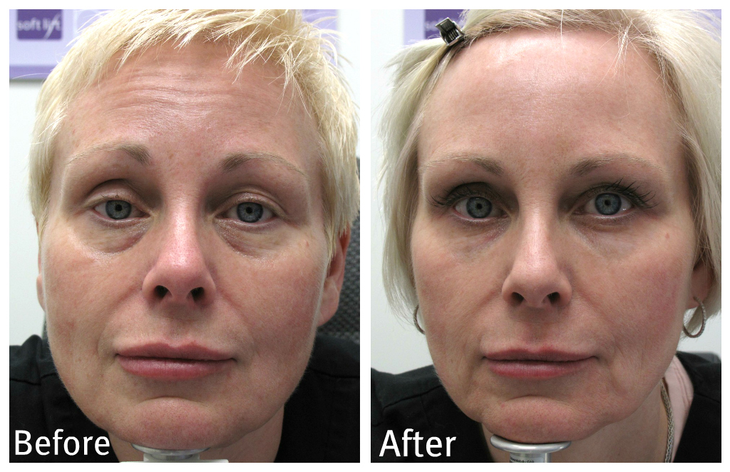 Guelph Medical Laser Before & Afters