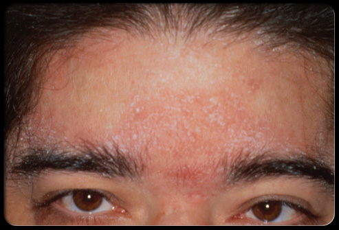 facial rash #9
