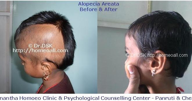 Vivekanantha Homeo Clinic & Psychological Counseling Centre, Chennai:  Alopecia Areata அலோபிசியா எரேடா சிகிச்சை தமிழ் நாடு