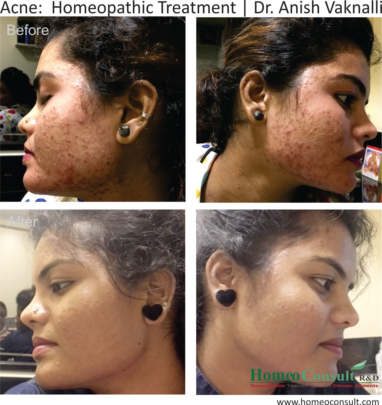 HomeoConsult RD Acne and homeopathy treatment, medicines