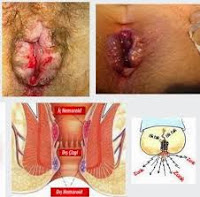 Cara Menyembuhkan Ambeien Setelah Melahirkan Dengan Obat Alami Cara Menyembuhkan Ambeien Setelah Melahirkan Dengan Obat Alami