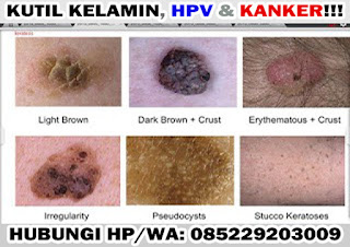 Obat Kutil Kelamin Obat Kutil Kelamin
