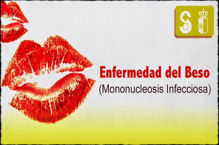 Enfermedad del beso mononucleosis sintomas