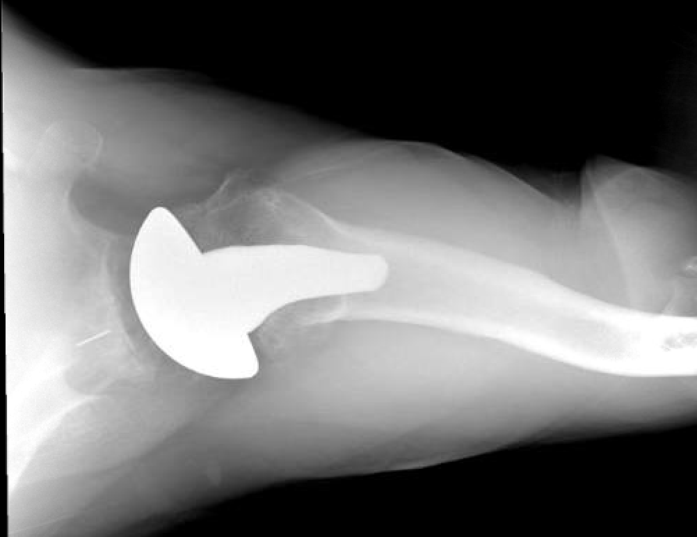 Shoulder and Elbow Surgery Short stems in anatomic total shoulder