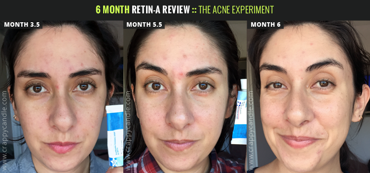 6 Month Retin-A Review - The Acne Experiment | Crappy Candle