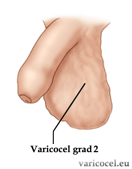 gironoterapie cu varicose vene reviews photo recenzii despre cream varicose venus