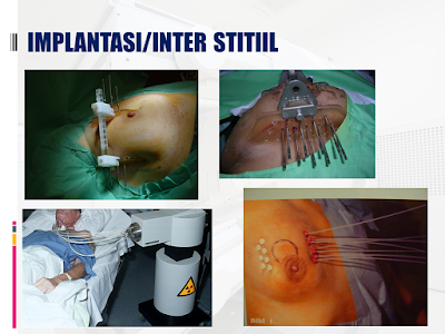 Implantasi/Inter Stitiil