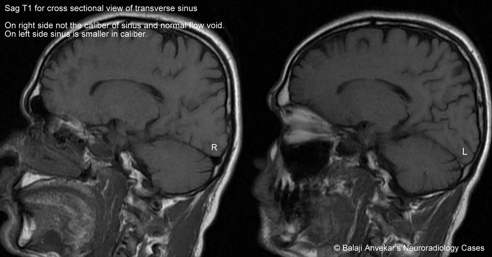 Гипоплазия правой головного мозга. Гипоплазия поперечного синуса мрт. Гипоплазия поперечного синуса слева. Тромбоз сигмовидного синуса на кт. Гипоплазия левого поперечного венозного синуса.