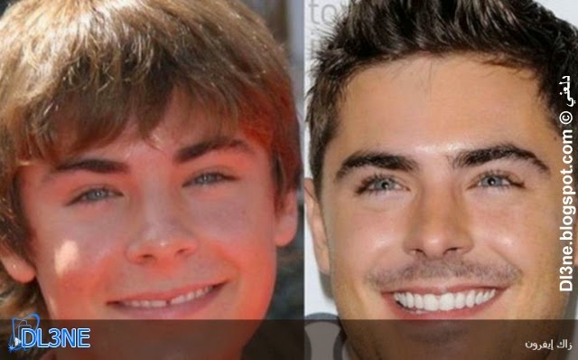 13 صورة تفضح أسنان مشاهير العالم قبل وبعد عمليات التجميل دلعني