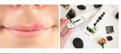 Para la boca en naturales remedios herpes