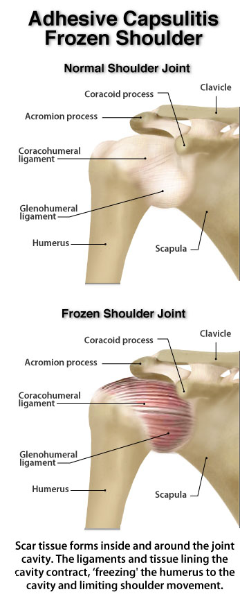Myo Therapy U0026 Healthcare Institute Frozen Shoulder