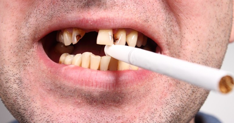 9 Facteurs de risque de perte de dent  Soins dentaires