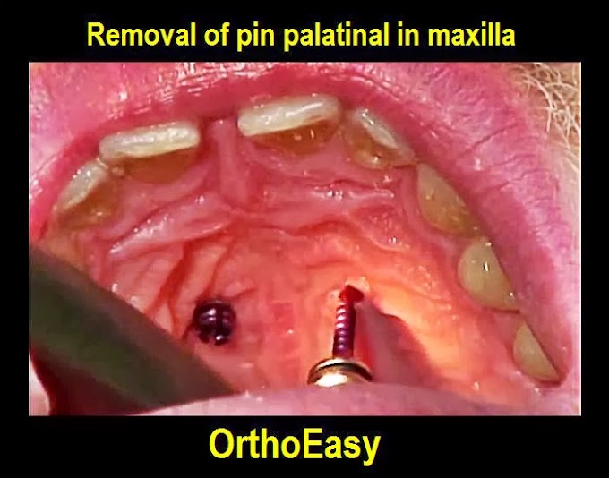 MINI IMPLANT: Removal of pin palatinal in maxilla