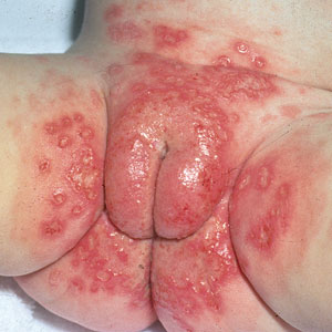 cara menghilangkan penyakit herpes