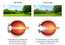 Cataract Surgery & Lens Implant Patient Satisfaction