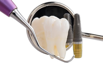 Cấy ghép răng implant ở đâu tốt?