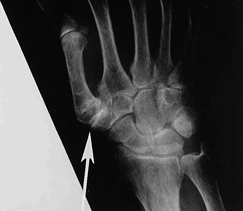 Medical Taber's Medical Dictionary Arthritis