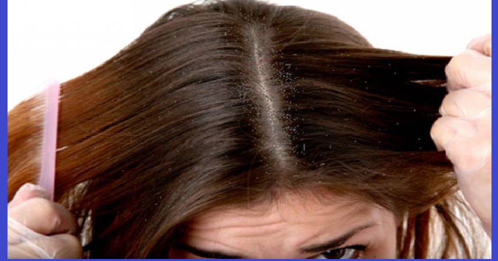 5+ Arti Mimpi Rambut Kutuan