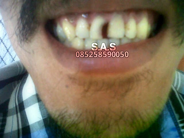 Mengatasi Gigi Rusak dan Hitam di Depan | AHLI GIGI PATI ...