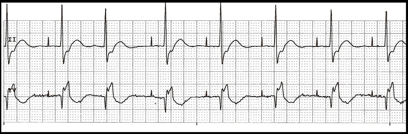Float Nurse: Basic EKG Test 59
