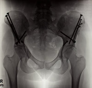 Hip Xray