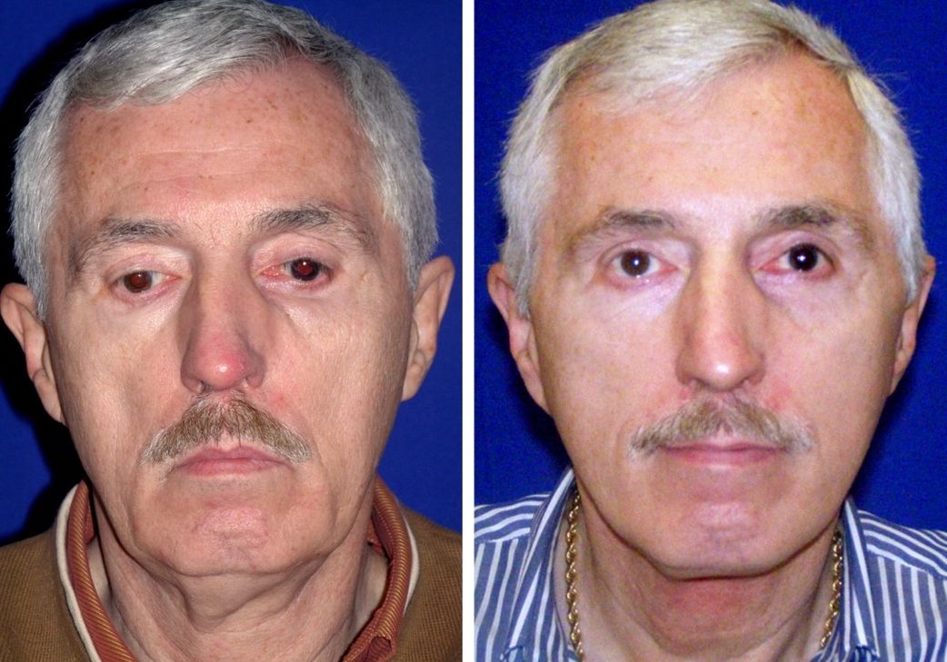 How To Look Younger With Simple Face Firming Exercises The Dynamics Of