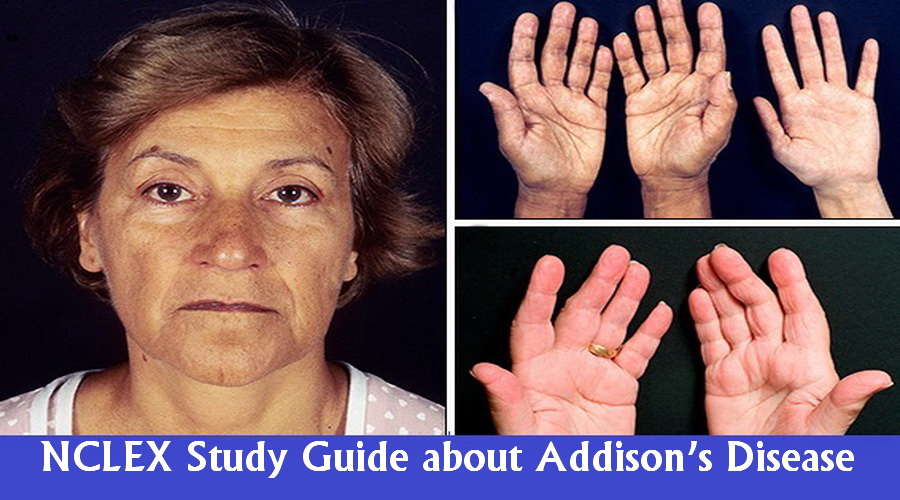 NCLEX Practice Question Addison’s Disease Government Jobs, MCQs & Information PK