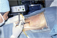 kidney stones nephrolithotomy percutaneous pcnl soda diet orange stone