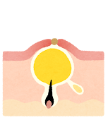 毛穴のイラスト(ニキビ)