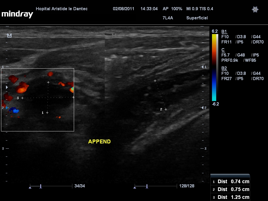 CES Imagerie Médicale UCAD APPENDICITE à l'échographie