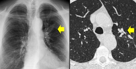 Reducción del ruido en imágenes de tomografía computarizada usando un filtro  bilateral anisotrópico