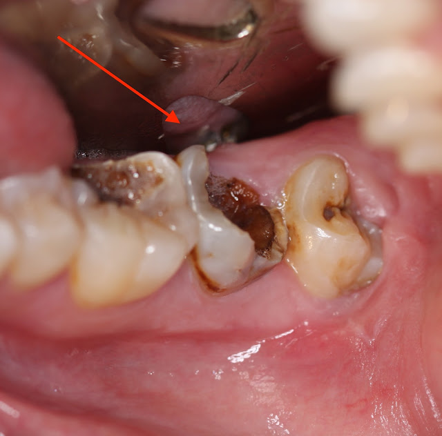 Sâu răng bị sưng má phải điều trị như thế nào?