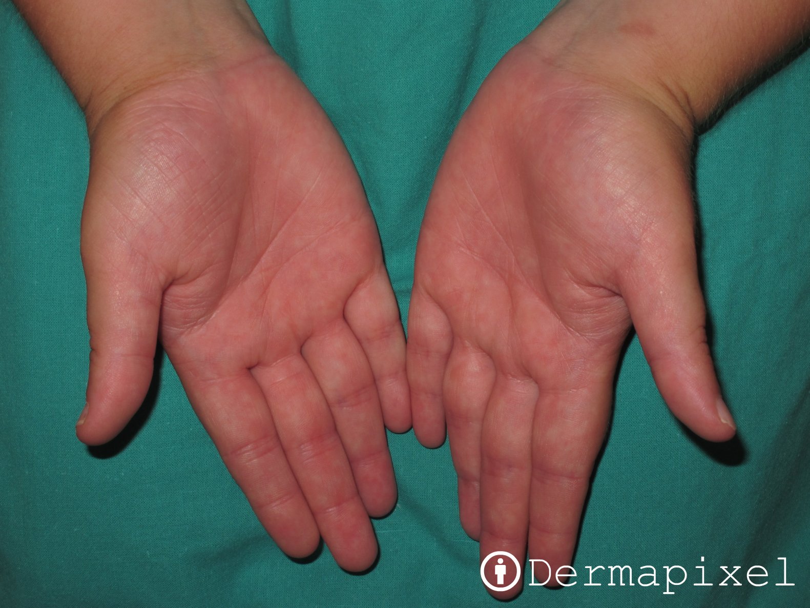 Dermapixel: El reto de la psoriasis palmo-plantar