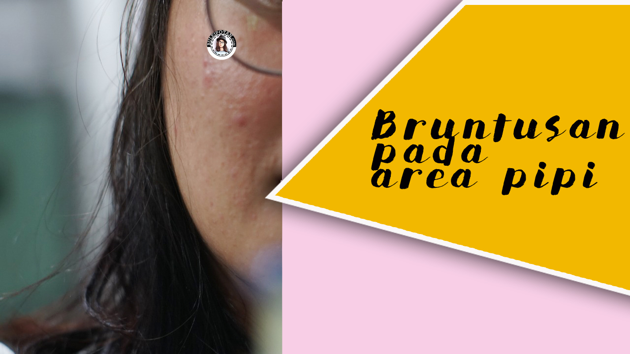 Kerja Keras Mengobati Bruntusan Buleipotan Beauty Blogger Indonesian