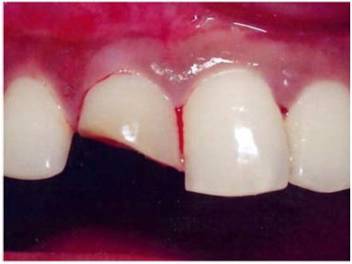 Ellis and Davey Classification - Endodontics and Oral Implantology