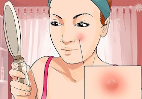 Home Remedies to Get Rid of Boil