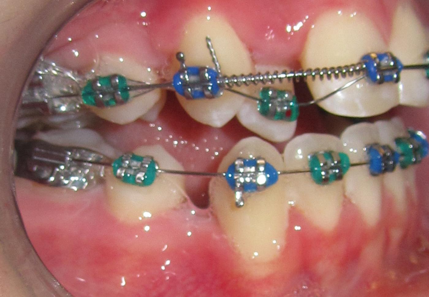 practical orthodontics Anterior labial root torque