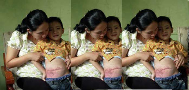 Kisah Seorang Anak Pecandu Mi Instan, Usus Dipotong Dua Kali Kisah Seorang Anak Pecandu Mi Instan, Usus Dipotong Dua Kali